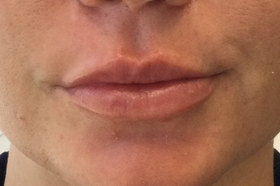 Lip fillers with a soft, natural finish