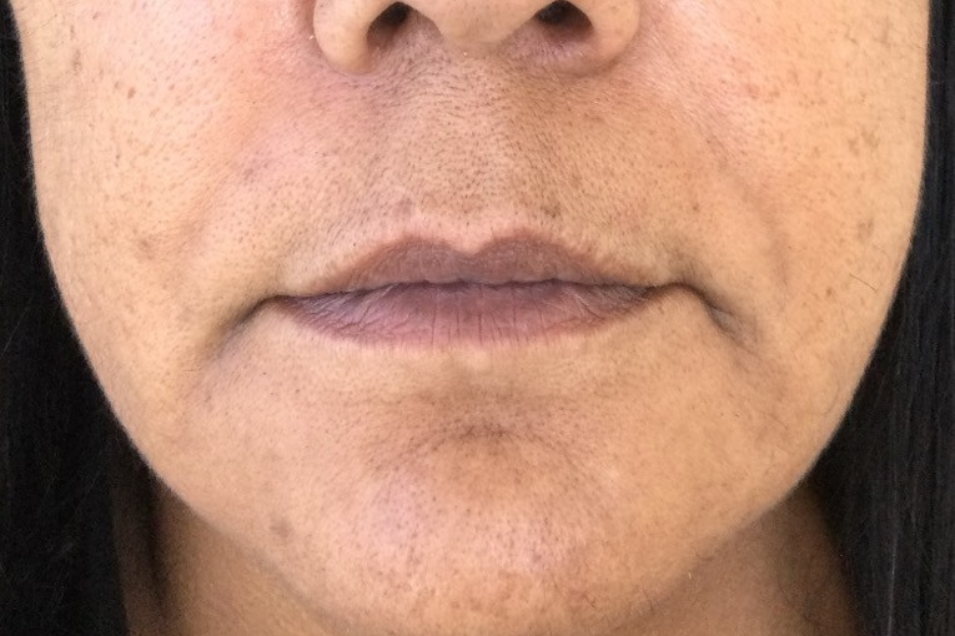 Dermal fillers for smile lines and jawline refinement