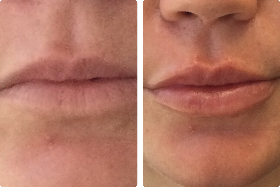 Lip fillers with a soft, natural finish