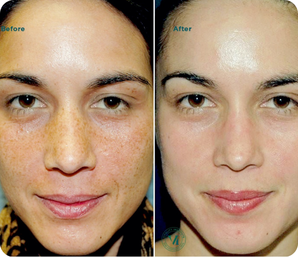 Before and After Chemical Peel